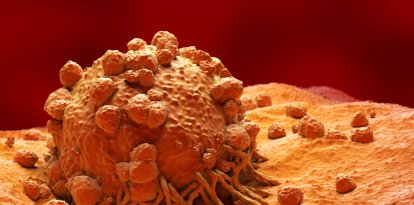 Imagen de un Melanoma, en visión microscópica