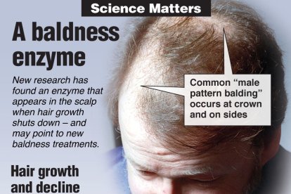 Estudio sobre la calvicie