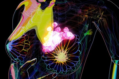 Una ilustración conceptual de cáncer de mama (Archivo)