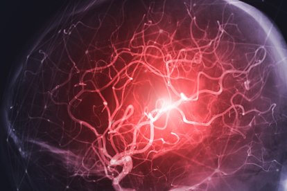 Ictus, imagen conceptual. Angiografía (radiografía de vasos sanguíneos) de las arterias cerebrales. (Archivo)