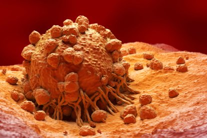 Imagen de un Melanoma, en visión microscópica