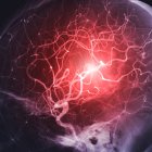 Ictus, imagen conceptual. Angiografía (radiografía de vasos sanguíneos) de las arterias cerebrales. (Archivo)