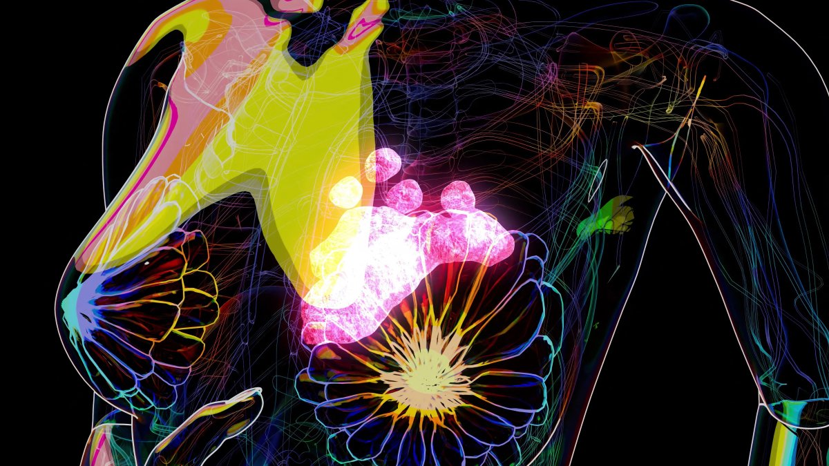 A conceptual illustration of breast cancer (Archive).