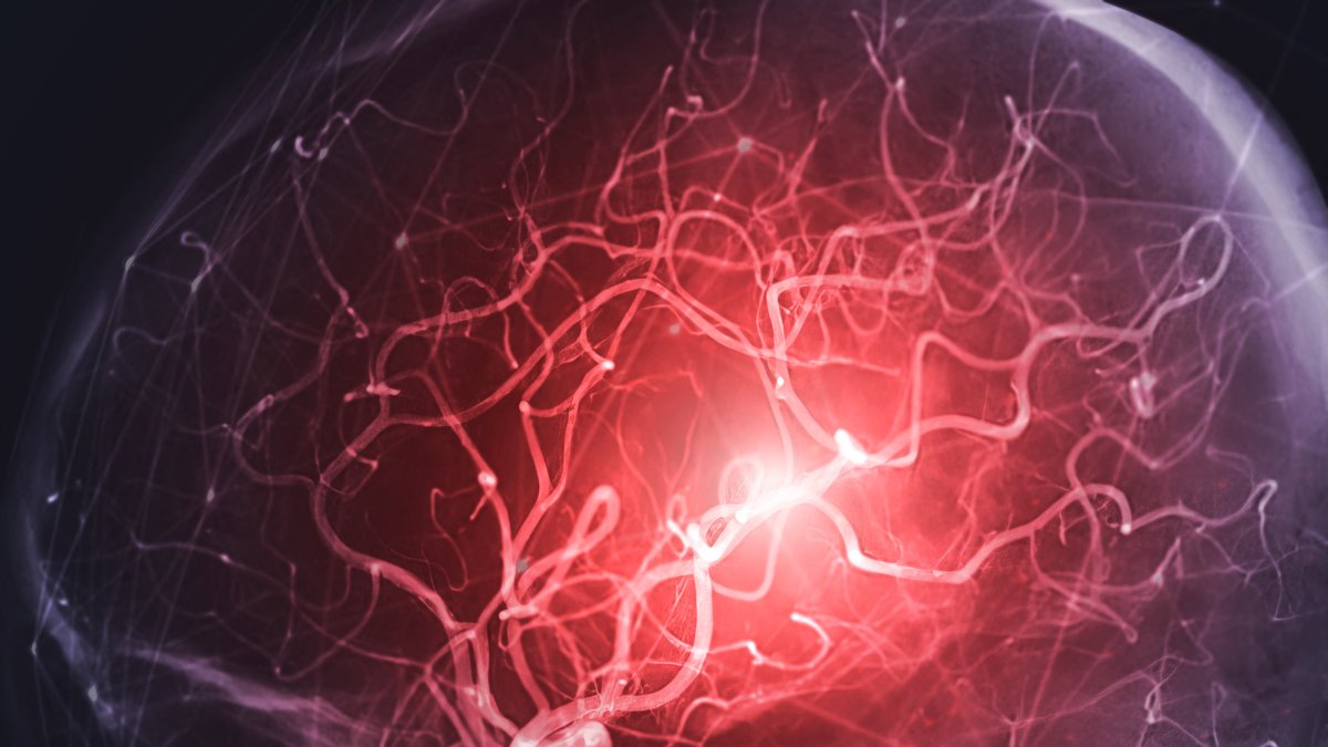 Stroke. X-ray of blood vessels in the cerebral arteries. (File photo)
