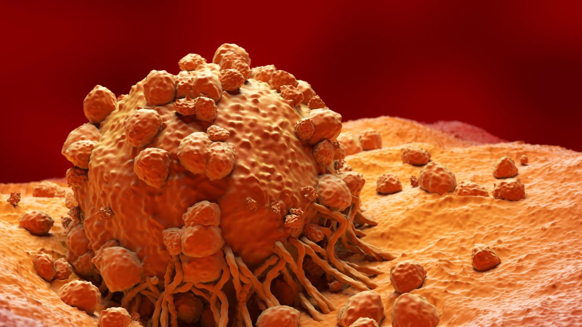 Imagen de un Melanoma, en visión microscópica