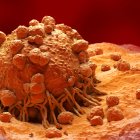 Imagen de un Melanoma, en visión microscópica